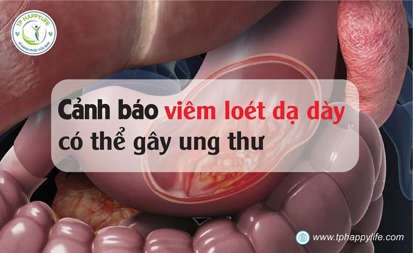 Cảnh báo viêm loét dạ dày có thể gây ung thư.