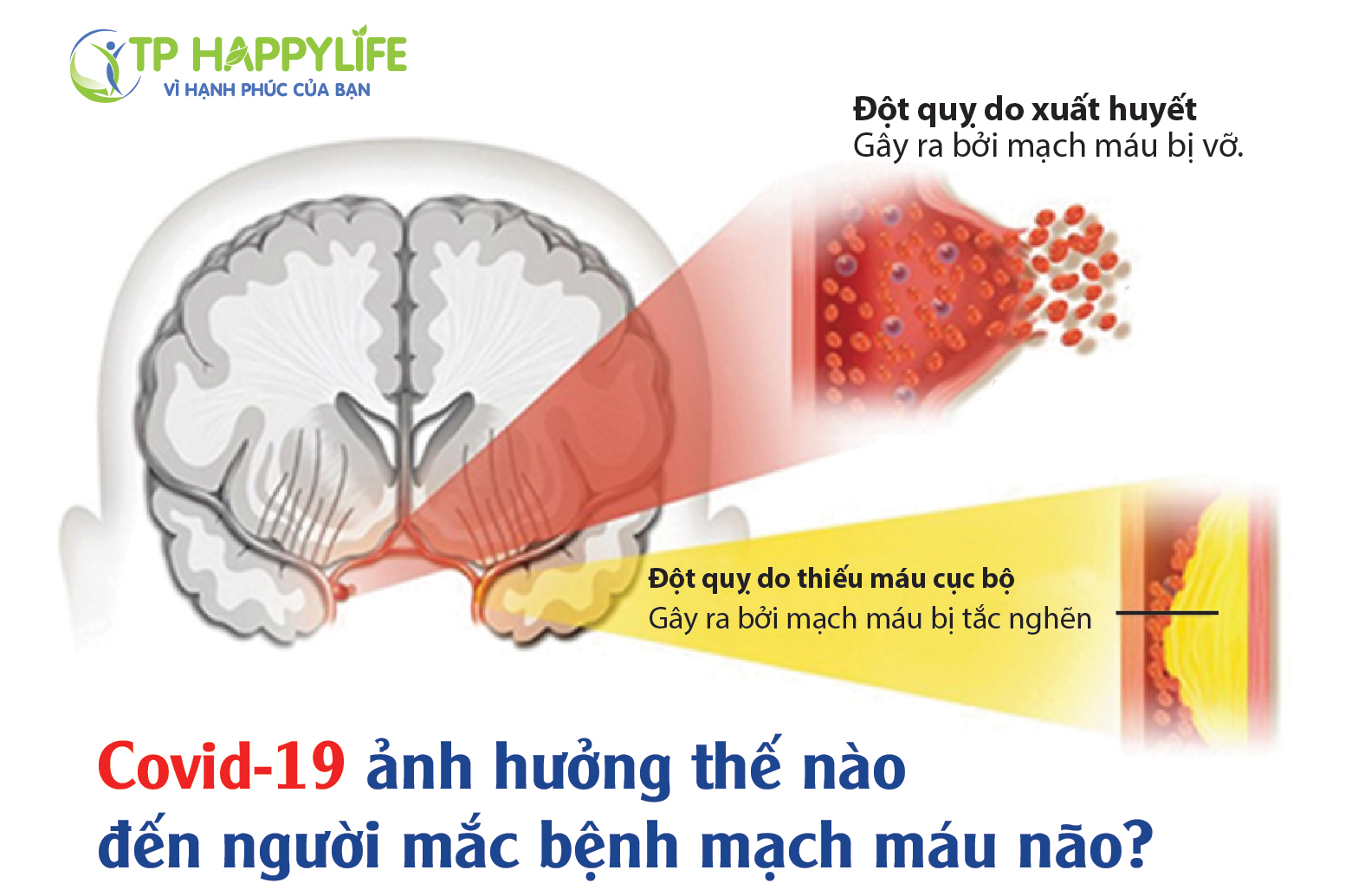 Covid-19 ảnh hưởng thế nào đến người mắc bệnh mạch máu não.