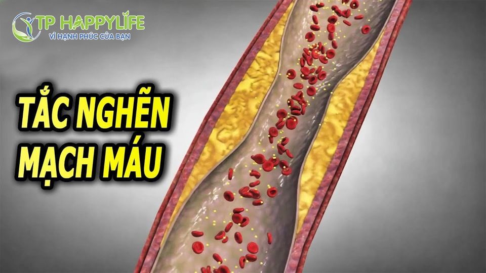 MẠCH MÁU TẮC Ở ĐÂU LÀ BỆNH Ở CHỖ ĐÓ